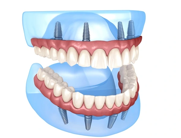 all on 4 dentures in vienna wv