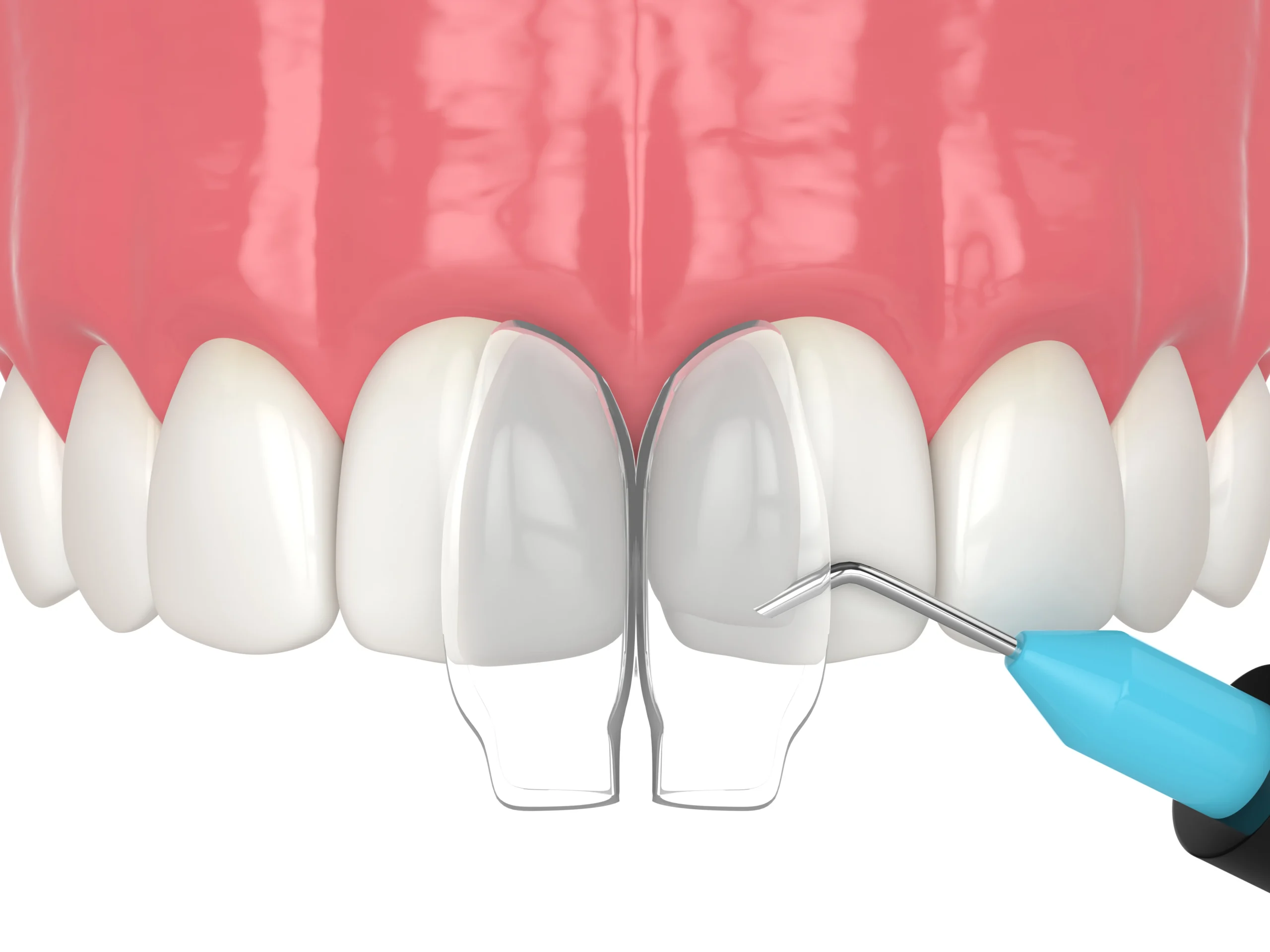 dental bonding near you