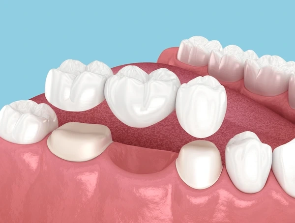 dental bridges in vienna wv