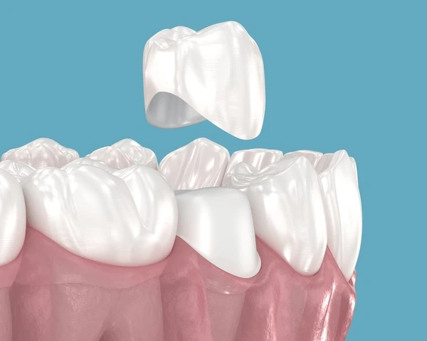 dental crowns near you