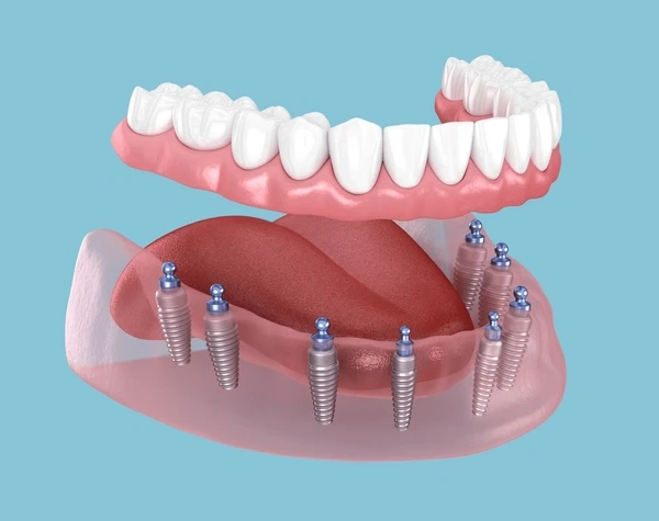 implant supported dentures in vienna wv