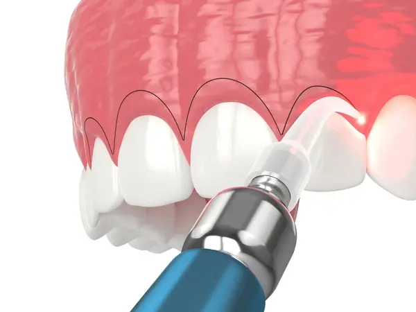laser gum disease treatment near you