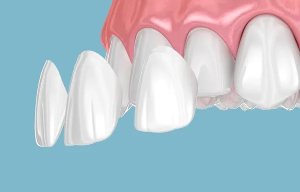 porcelain veneers in vienna wv