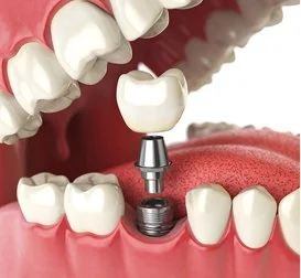 dental implant solutions at our office