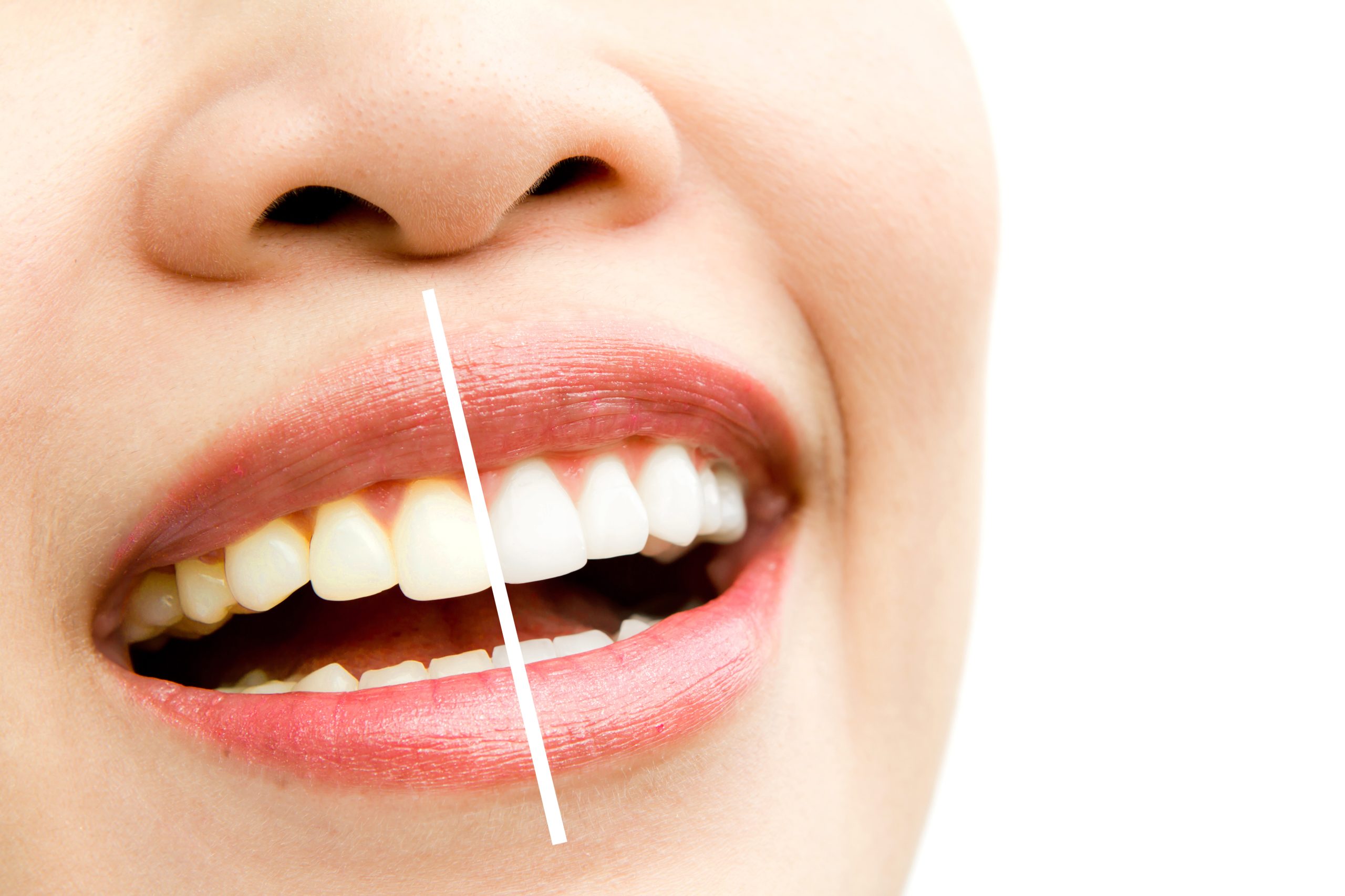 What Can Professional Teeth Whitening Do for Your Smile?